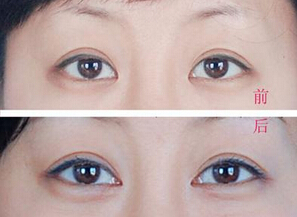 哪些人适合开内眼角手术