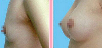 艾菲尔美胸前后对比