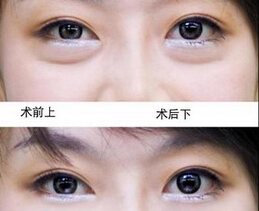 女人如何有效去眼袋