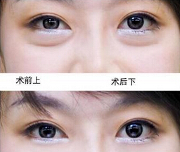 成都祛眼袋哪里好呢