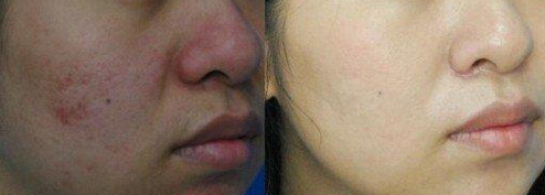 激光治疗痤疮究竟如何