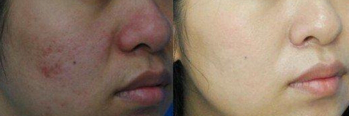激光治痤疮的效果如何