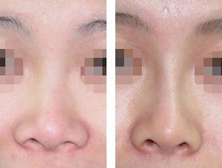 可以经常注射隆鼻吗