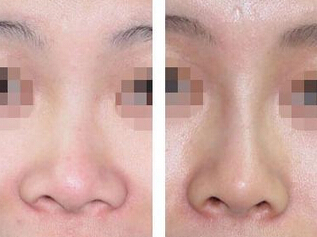 做隆鼻会引起鼻炎吗