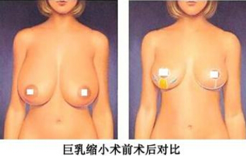 乳房肥大怎么缩小好