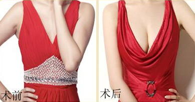 成美的丰胸整形怎么样