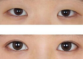 遂宁开眼角贵吗