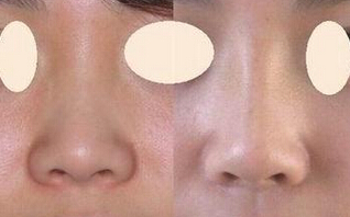 鼻头又圆又大怎么办好呢