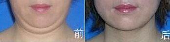 双下巴吸脂痛吗