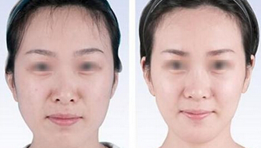 削骨瘦脸效果明显吗