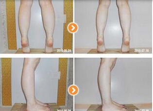小腿吸脂手术