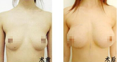 假体隆胸能做多大