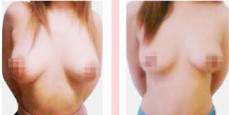 巨乳缩小术到底怎么样呢