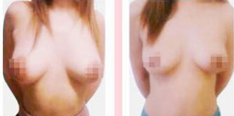 乳房缩小术