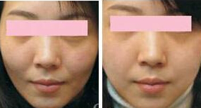 一般去颊脂垫费用多少