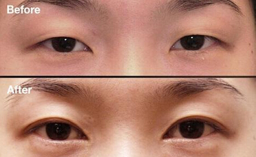 男生眼睛小怎么办才好