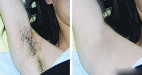 冰肌脱毛要多少钱合理