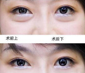 内切祛眼袋会留疤痕吗