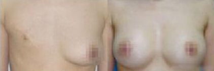 乳头再造有用吗