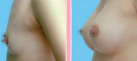 假体隆胸会失败吗