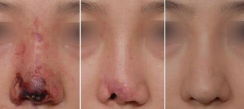 隆鼻失败如何修复好
