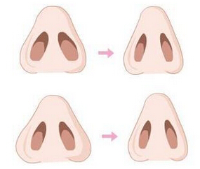 女人鼻孔大怎么办呢