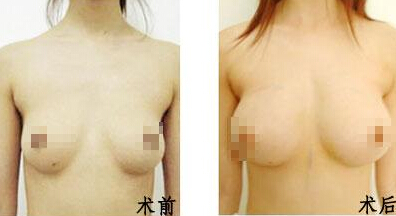假体隆胸后消肿要好久
