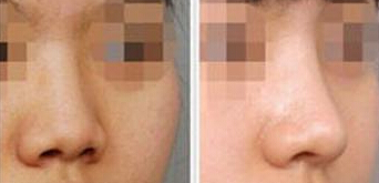 短鼻矫正术效果如何