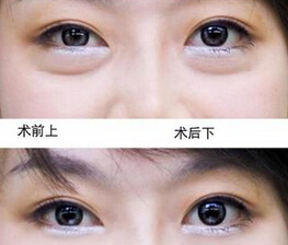 激光去眼袋效果好不