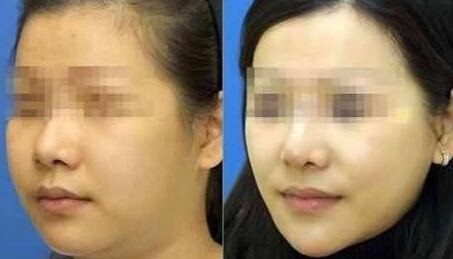 成都面部吸脂哪里好