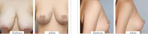 乳房上提固定术怎么样