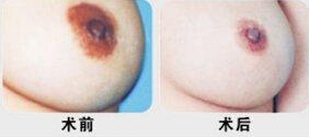 乳头大怎么改小