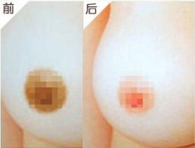 大乳头能缩小么