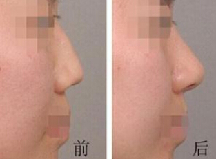 未成年能隆鼻么