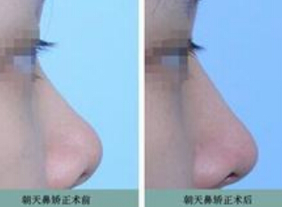 朝天鼻怎样整形