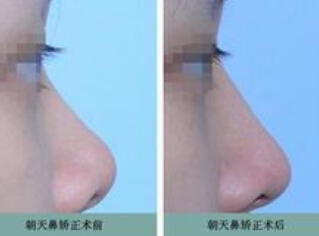 朝天鼻怎么整形才好看