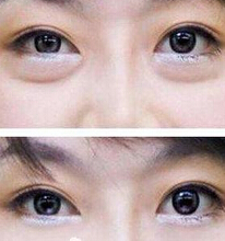 眼袋吸脂要几天能消肿