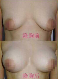 硅胶假体隆胸的效果怎样