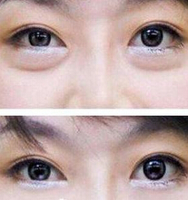 割眼袋价格是多少