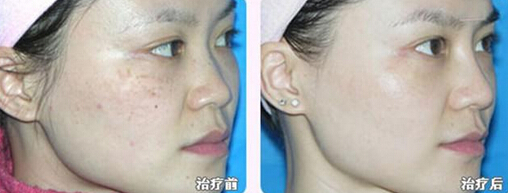 光子嫩肤和彩光嫩肤哪个比较好