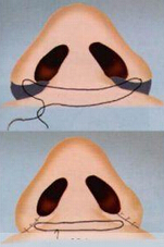 遂宁鼻翼缩小多少钱