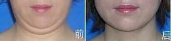 做双下巴吸脂痛苦吗