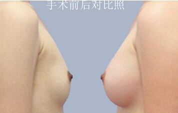 到底假体隆胸手感软吗