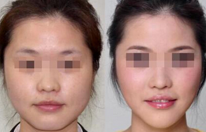 脸颊过宽怎么改善