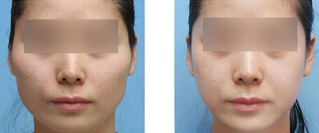 成都颧骨磨削手术后如何护理