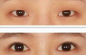 小眼症矫正全析