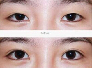 切开双眼皮多久恢复自然