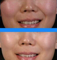 光子嫩肤有哪些功效