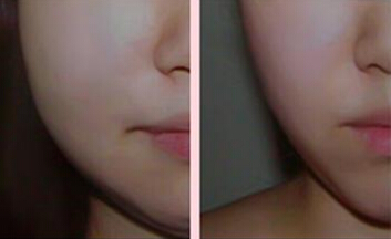 瘦脸针价格