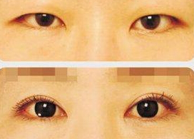 南充割双眼皮多少钱